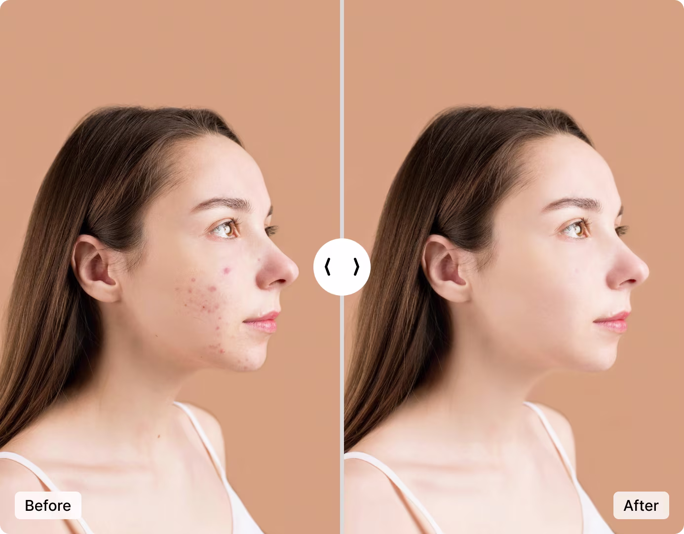 Close-up portrait showing blemish removal — acne and dark spots cleared by AI